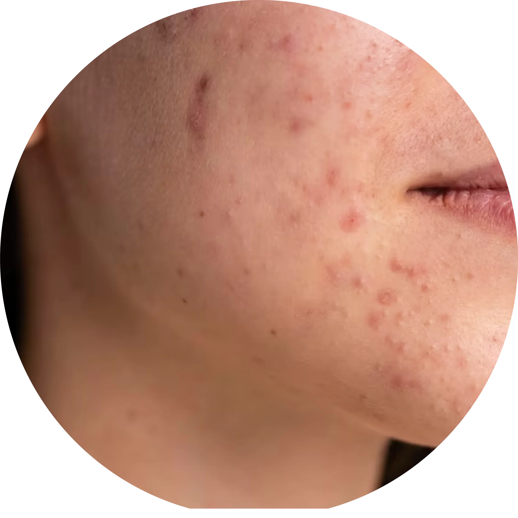 acne-1667x-673f63d643aa7