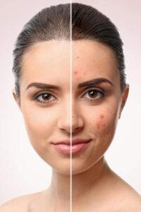 Rose Water for Summer Skincare