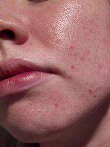 What causes dandruff