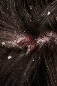 What causes dandruff