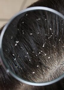 What causes dandruff