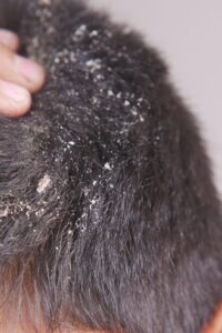 Greasy scalp and flakes