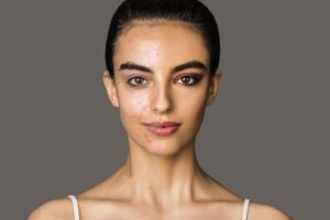 Reduce Pigmentation Naturally