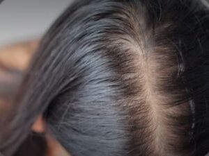 Oily Scalp Solutions