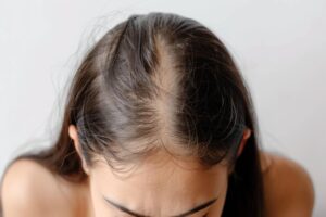 Oily Scalp Solutions
