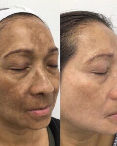 Reduce Pigmentation Naturally