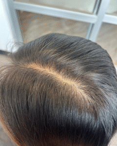 Post-Diwali Scalp Detox