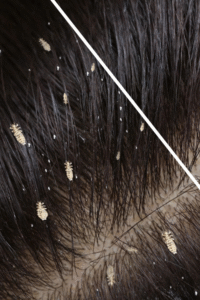 itchy scalp causes