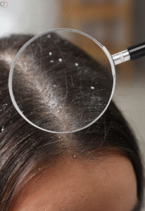 How to Get Rid of Dandruff Naturally