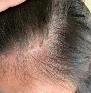 rosemary anti dandruff gel