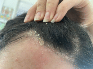 Persistent Dandruff